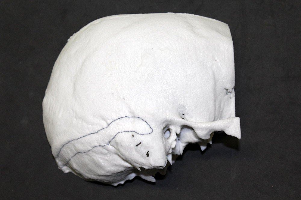 Temporal bone 3D printed models can be used by surgeons to properly plan the placement of hearing aids and prosthesis.
