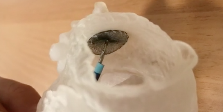 3D Printed Model of the left Atrium to Plan Atrial Appendage Closure in ...