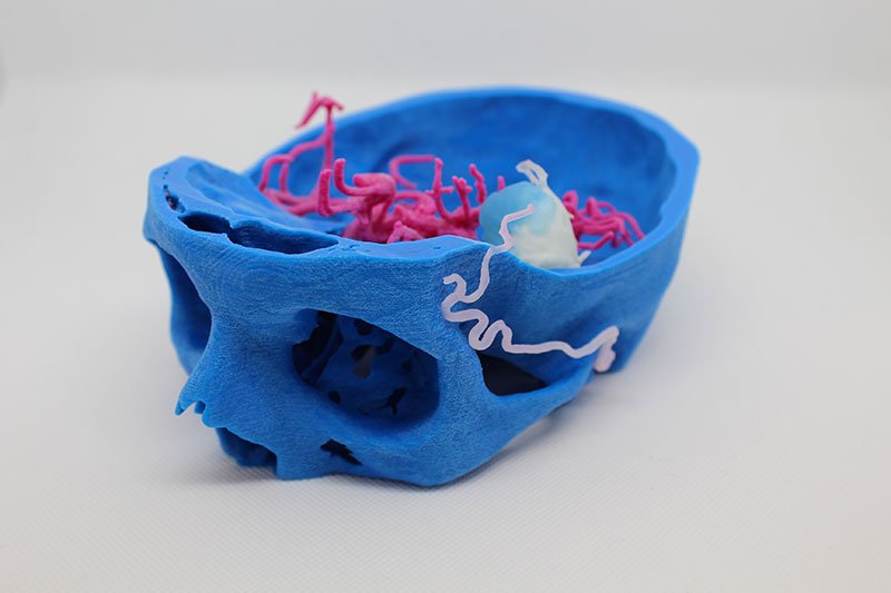 3D printing allows a precise reproduction of the morphological and pathological characteristics of subtle cerebral vessels enabling neurosurgical planning and simulation.